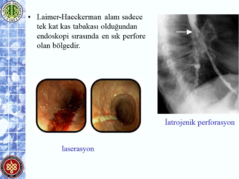 Laimer-Haeckerman alanı sadece tek kat kas tabakası olduğundan endoskopi sırasında en sık perfore olan